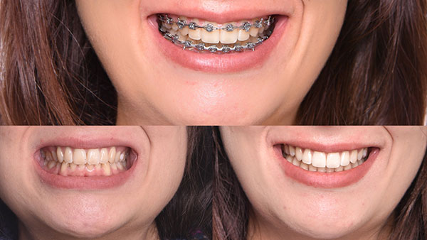 Smile Arc Technology Treatment Example