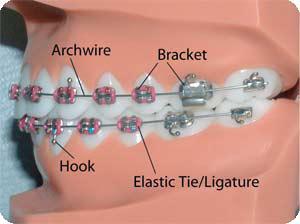 Parts of Traditional Braces